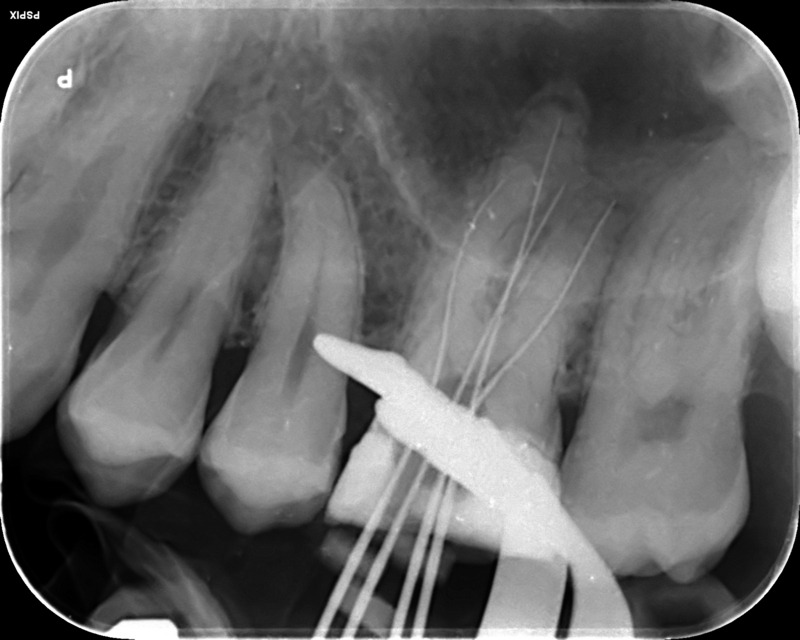 UL6 internal inflammatory resorption case image 3